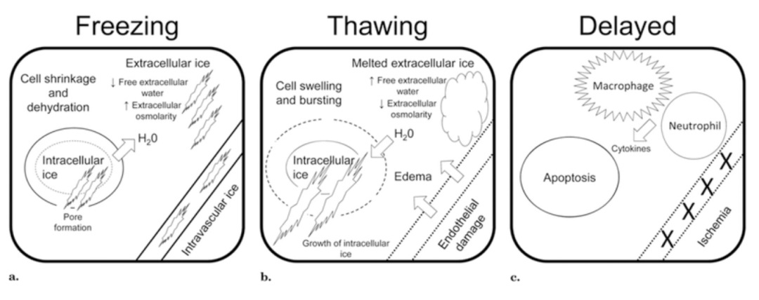 肿瘤医治界的「高冷之花」——肿瘤微创冷冻消融，，，，，，，国产代替设备空间巨大