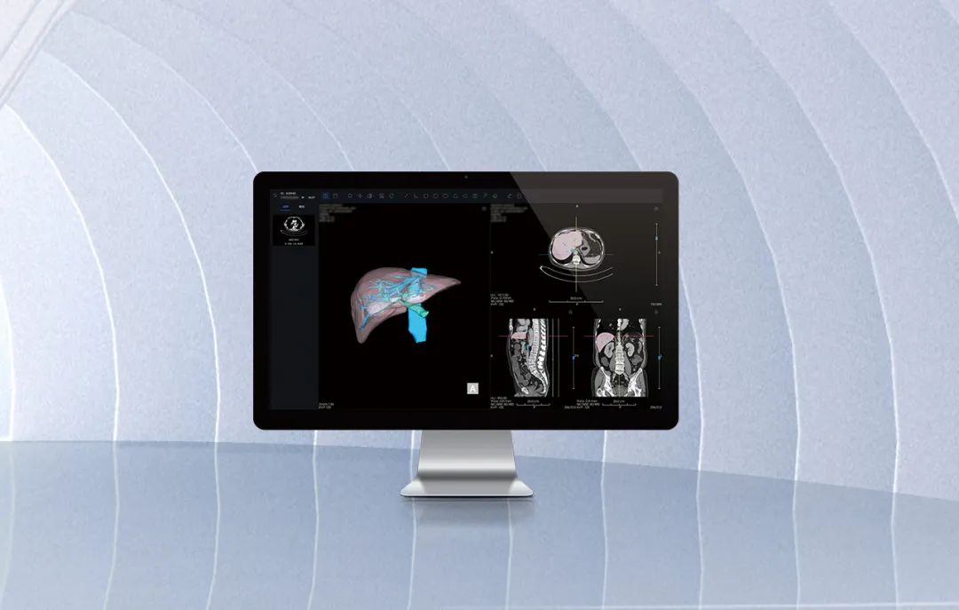 北京市首款！7790必发集团官网医疗自主研发的AI+肝脏CT影像处置软件获批上市！